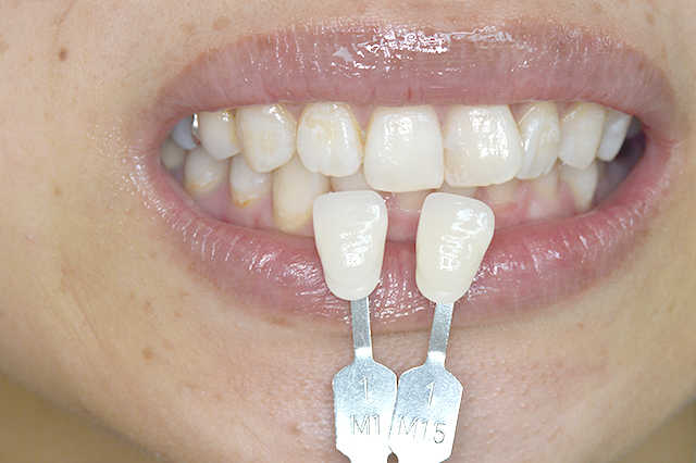 STEP11.歯の色の確認