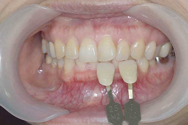 STEP1.歯の色の確認