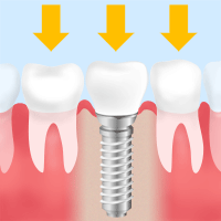 チタン製の人工歯根を埋め込む治療法～インプラント～