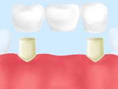 健康な歯に人工歯の橋を架ける治療法～ブリッジ～