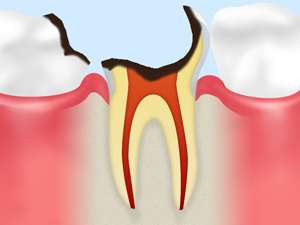 C4 歯根まで達した虫歯